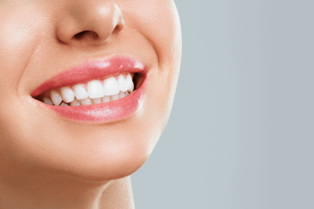 Woman with dental veneers