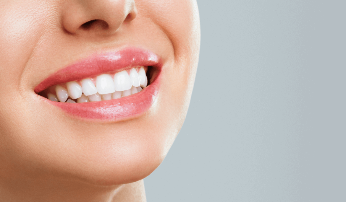 Woman with dental veneers